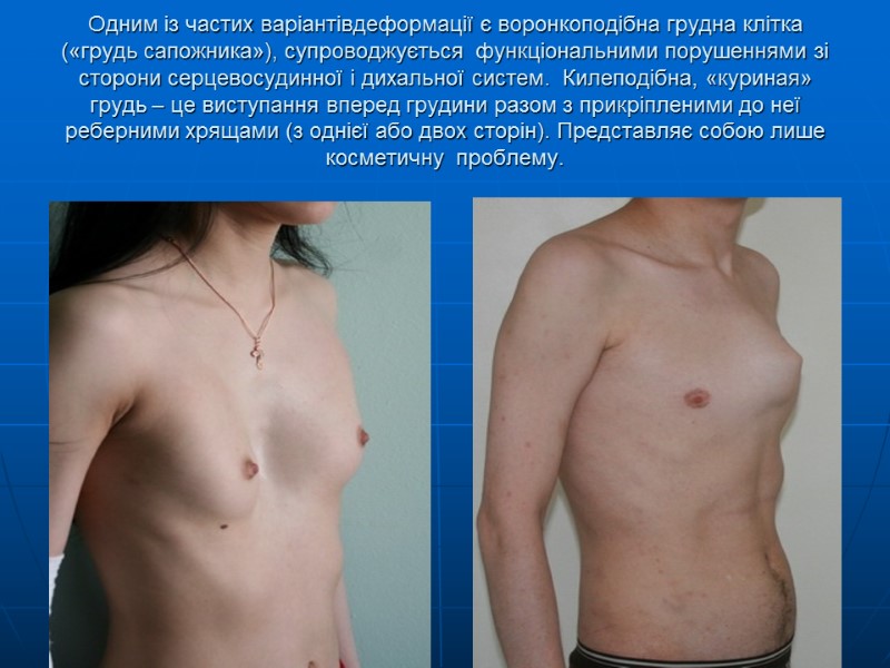 Одним із частих варіантівдеформації є воронкоподібна грудна клітка («грудь сапожника»), супроводжується  функціональними порушеннями